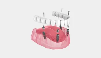 8 Long-Term Stability Benefits of Implant-Supported Dentures