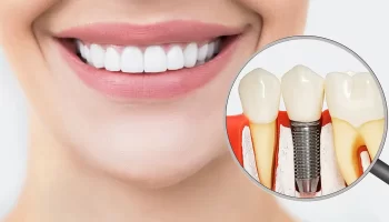 How Do Dental Implants Restore Long-Term Oral Function?